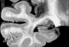 Capillary telangiectasis, insular cortex